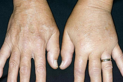 风湿免疫科医生:记住这2种药,降尿酸,控制痛风不再难