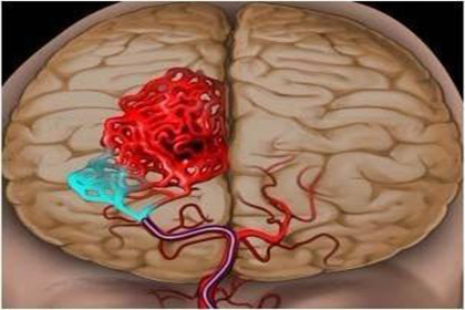 高血压脑出血的内外治疗法