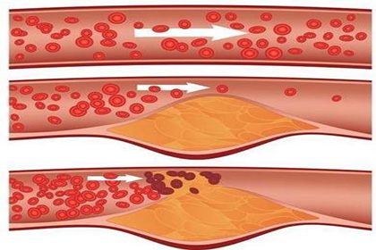 血管堵塞不容忽视,疏通血管吃这8种食物