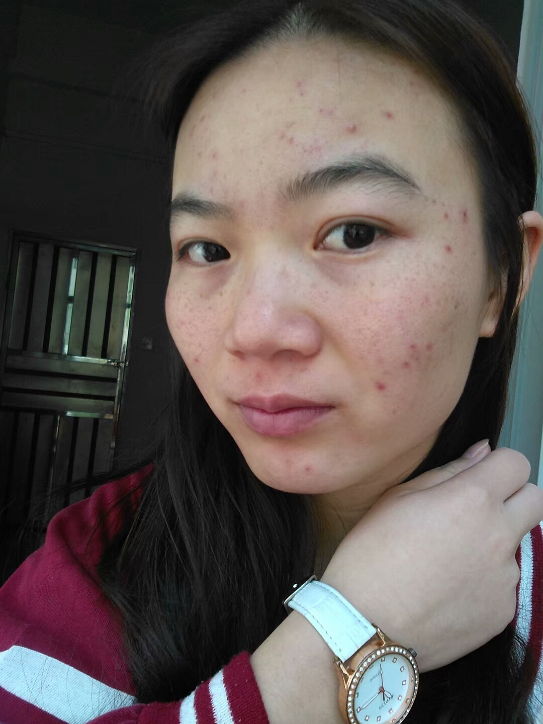 青春期长痘不管不顾会不会自己好转,青春痘会不会自己好