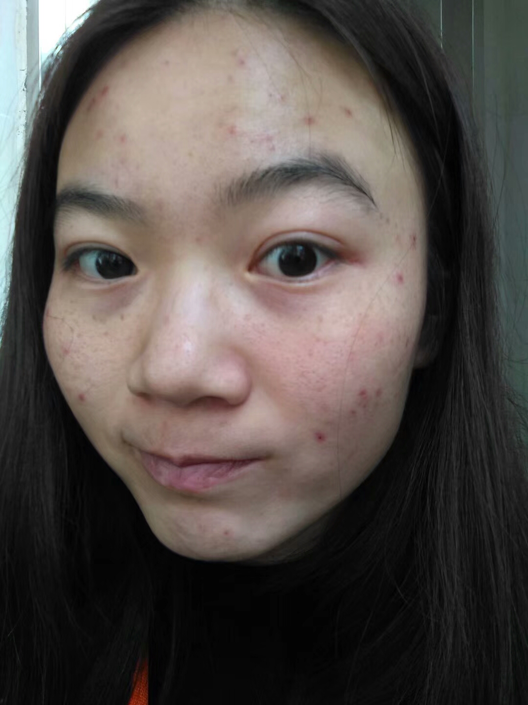 学生去除青春痘小妙招,正确祛痘涨姿势祛痘了无痕