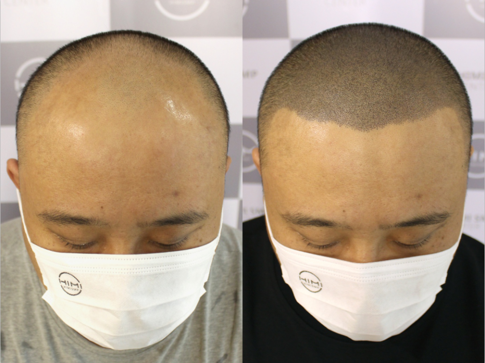 _深圳福田秃顶纹发电话,3/5小时完成即时可看效果_深圳市青逸纹发